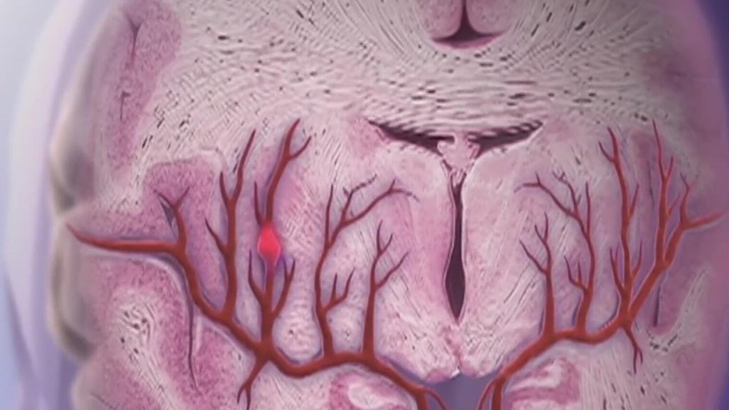 Knowing the signs of a stroke can save lives — Augusta Community news